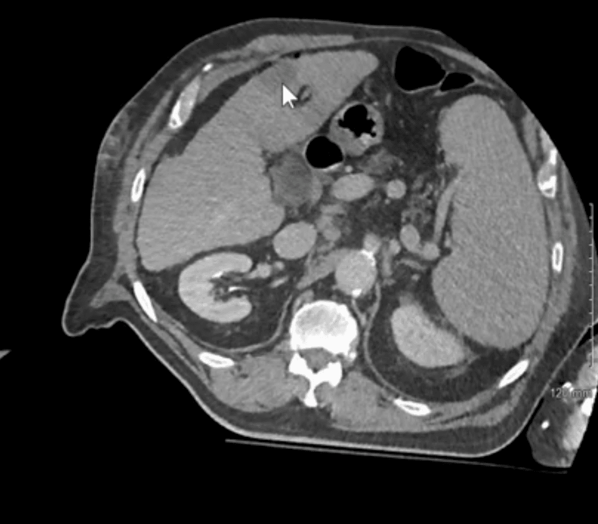 CT-Guided Liver Hepatocellular Carcinoma Ablation with Cascination CAS-One IR