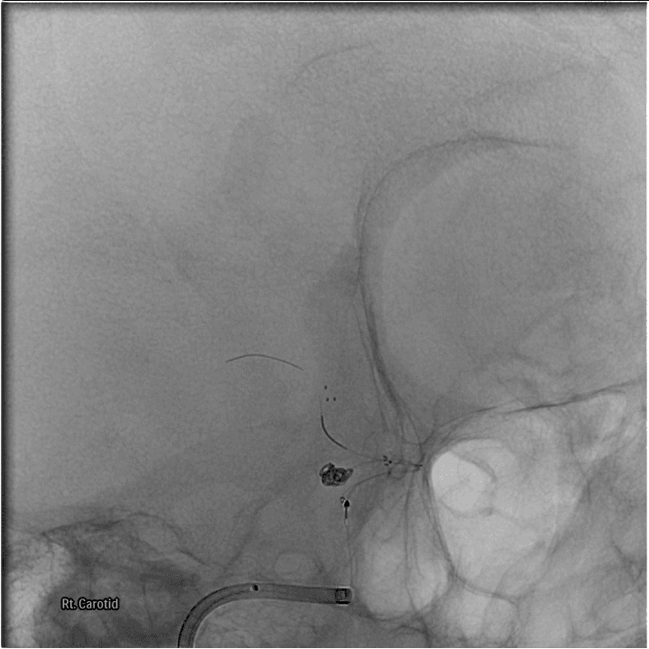 Cerebral Aneurysm Coiling